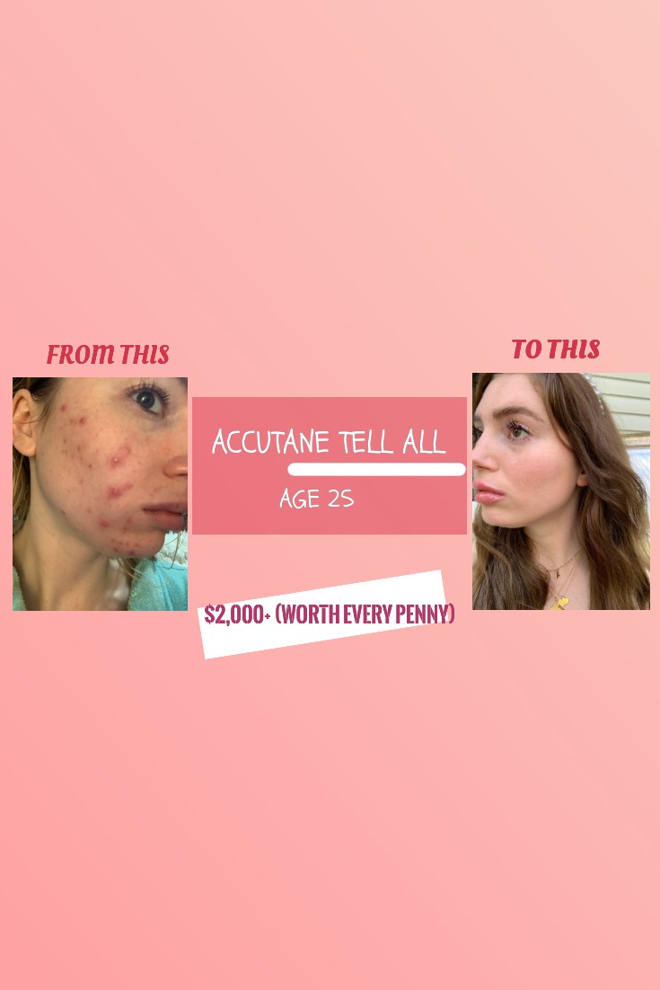 ACCUTANE TELL-ALL AT AGE 25: Is $2,000 for Clear Skin worth it?! Everything YOU NEED TO KNOW
